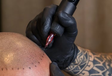 séance de greffe capillaire sur un homme atteint de calvitie totale