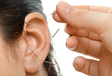 Chinese TCM acupuncture on a woman's ear