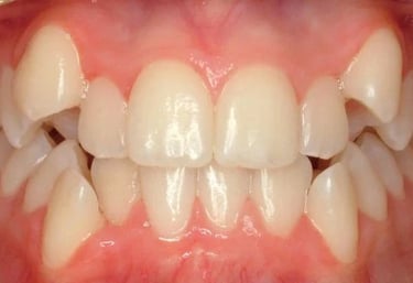 affordable tooth removal