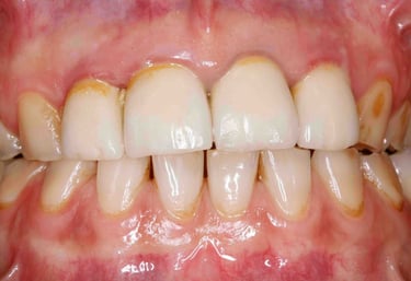 tooth cleaning in baner