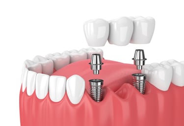 dental implant near you