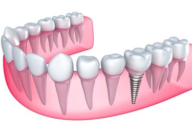 single tooth prosthetics