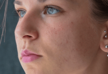 piercing e furo de orelha humanizado