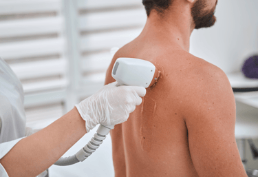 hombre en sesion de depilacion laser