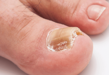 onicomicosis