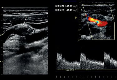 Duplex carotid ultrasound image showing vascular stenosis.