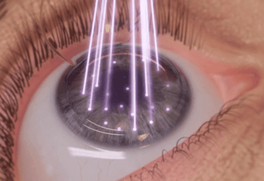 Cirugía láser ocular en Guayaquil