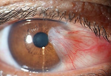 Tratamiento del Pterigión o Carnosidad en el ojo en Guayaquil