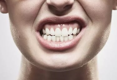 Tratamento para bruxismo em Curitiba com placa de proteção e acompanhamento odontológico.
