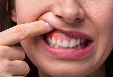 Tratamento e prevenção periodontal em Curitiba para gengivas saudáveis e livres de inflamação.