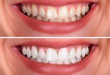 a woman's teeth whitening and teeth whitening