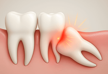 wisdom tooth extraction at Peoples Dental Clinic Greater Noida