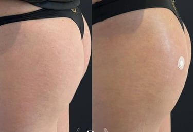 harmonização de glúteos procedimento estético - Tatuapé São Paulo