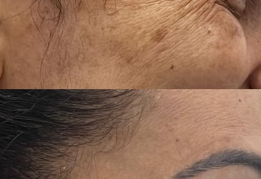 skinbooster hidratação profunda da pele - clínica Tatuapé