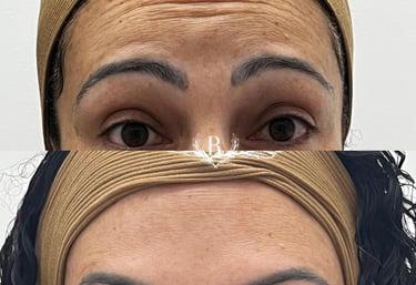 aplicação de toxina botulínica no rosto - clínica Tatuapé