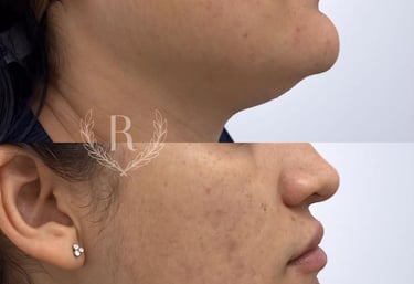 mesoterapia facial e corporal - clínica estética Tatuapé