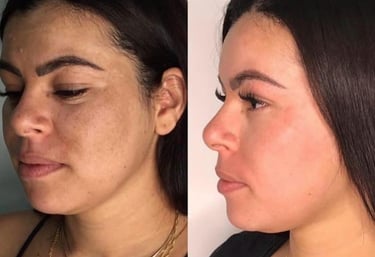 peeling facial renovação da pele - clínica estética Tatuapé