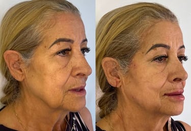 tratamento com exossomos regeneração da pele - Tatuapé