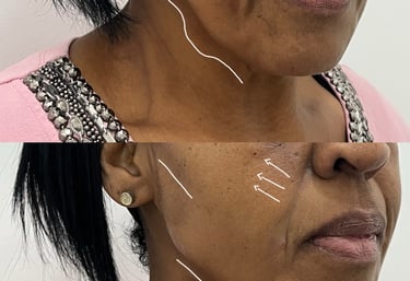 intradermoterapia facial e corporal - clínica Tatuapé