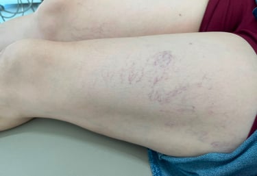 escleroterapia tratamento de vasinhos - clínica Tatuapé