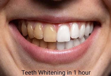 White straight teeth after teeth whitening at best dental clinic in Orlem Malad west Mumbai