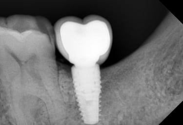 Dental implant for replacement of missing teeth done by best implants specialist in Orlem Malad West