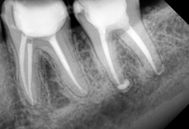 Best root canal treatment done at top dental clinic near Chincholi Malad west in Mumbai