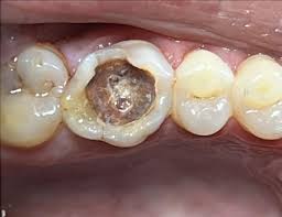 Gros plan d'une molaire avec une carie profonde visible nécessitant un plombage