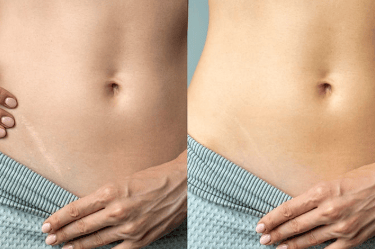 Imagen de cicatrización rapida