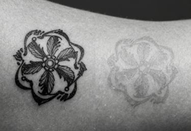 Close-up of a professional technician performing diode laser hair removal on a client's leg in a bright, serene clinic.