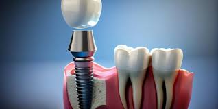 best dental implants in nagpur