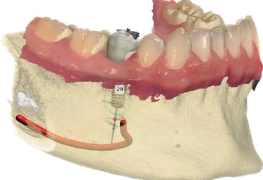 Guided Implantology in nagpur