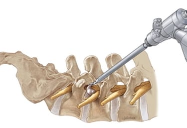 Foto esquemática mostrando uma endoscopia de coluna lombar. 