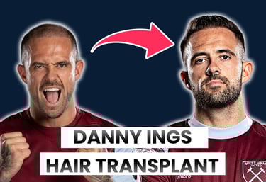 danny ings hair transplant