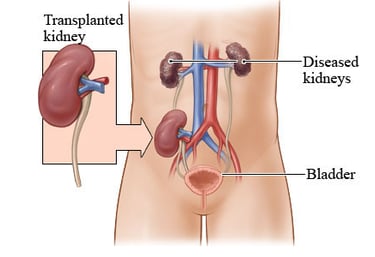 kidney transplant in jordan