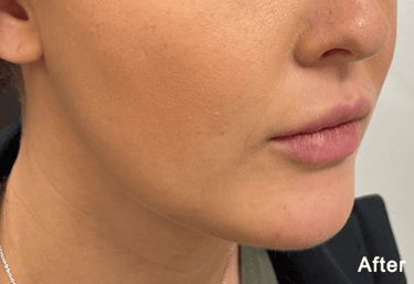 After QuantumRF Treatment