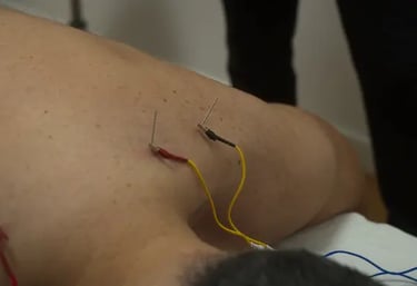 Electro Punción Fisioterapia Argoños