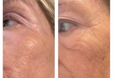 Before and after chemical skin peeling, skin boosters and fillers