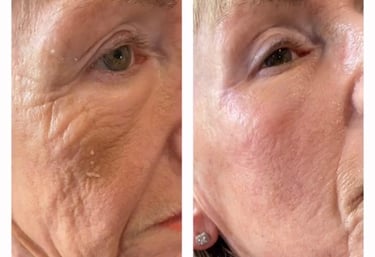 Chemical skin peels, skin booster and filler treatemnt