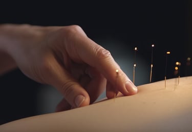 Close-up picture of an acupuncturist's hand inserting needles into a patient's skin.