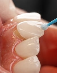 Veneers İzmir — hauchdünne Keramikschalen für ein natürliches Lächeln bei Designed Smiles