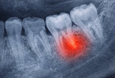 Tooth extraction Greenville SC