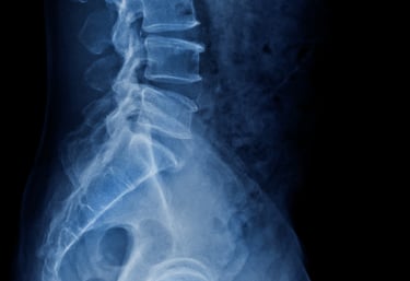 Röntgenbild av ländryggen i profil som används vid bedömning hos legitimerad kiropraktor i Malmö.