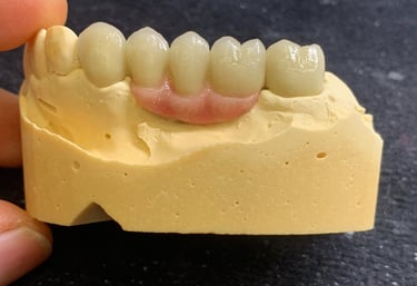 Puente Metalcerámica con encía cerámica GC