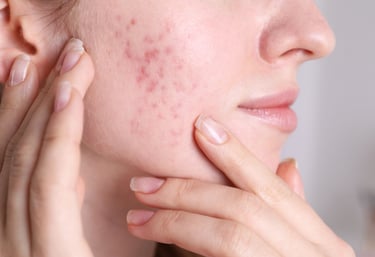 Acne & Rosacea Care