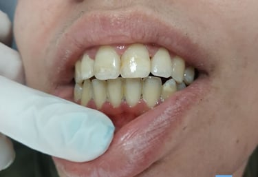 gingivitis