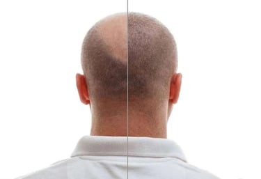 A before-and-after image of a patient showing successful hair transplantation results.