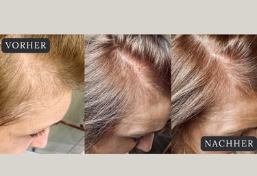 Vorher Nachher Bilder nach der Haarwachstums Therapie