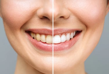 Una comparación de antes y después de un blanqueamiento dental, que muestra dientes amarillentos