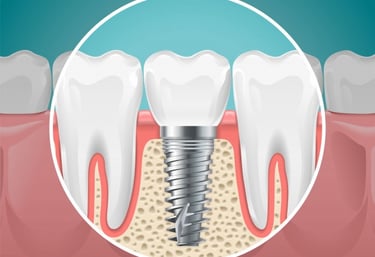 Un diagrama de un implante dental con tornillo y corona colocado en el hueso maxilar entre dientes.